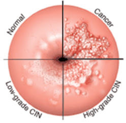 papilloma vírus és cin 3